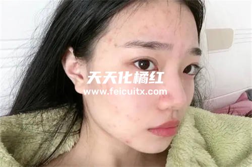 为什么有的人喝化橘红脸上会起痘